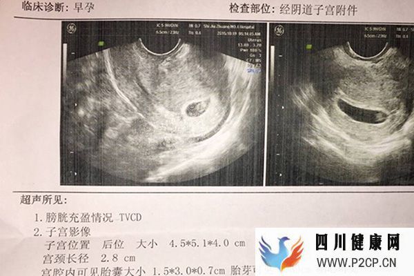 宫内有胎囊表示为宫内孕