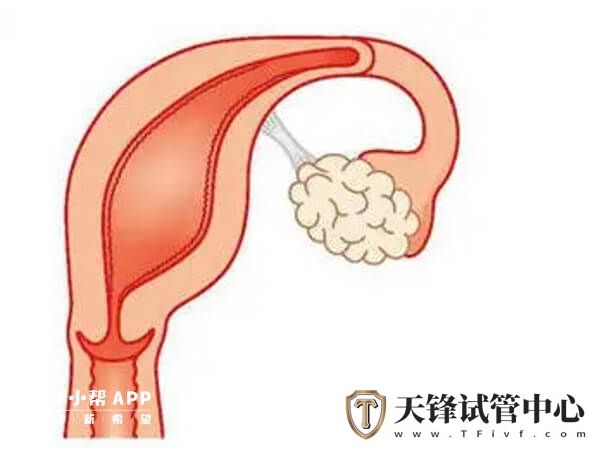 单角子宫做几代试管得看实际情况