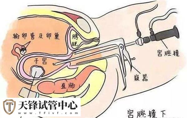 试管前宫腔镜不仅能检查还能治疗