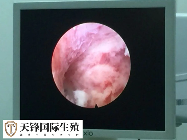 夫妻人授失败后转试管要查什么项目(图2) 宫腔镜检查能见检查子宫腔及输卵管