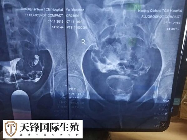 试管什么情况下需要冻胚移植(图2) 盆腔环境异常要进行冻胚移植